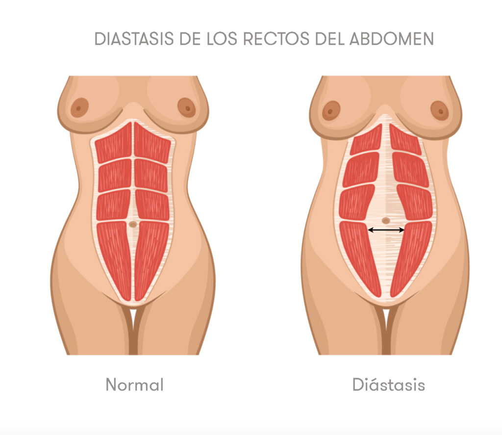 Diastasis o reparación rectos abdominales en abdominoplastia
